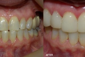 Gum Abscess Effective Treatment Allied