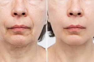 Non Surgical Face Lift Allied