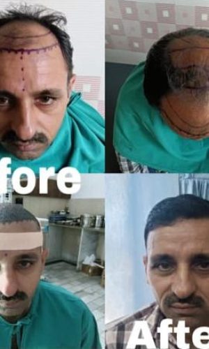 hair transplant images (4)