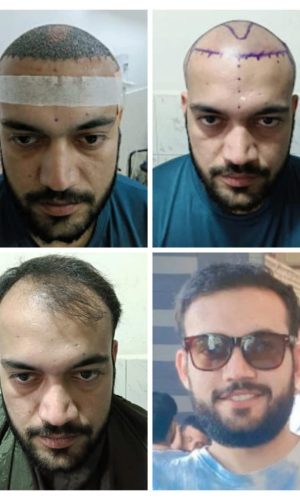 hair transplant images (6)