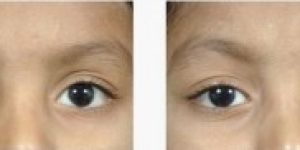 paediatric ophthalmology treatment Allied