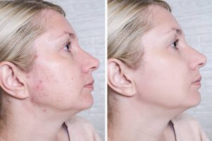 Young woman before and after anti acne treatment, skincare and dermatology concept.