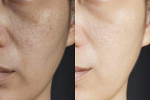 skin-treatment-ba02